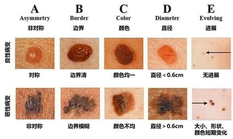 手臂有黑痣|身上长了黑痣就是黑色素瘤吗？该怎样判断？